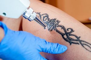 We use laser skin care for several treatments such as tattoo removal