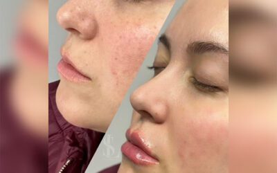 Silicon Valley Aesthetic Dermatology Announces Three New Posts for Skincare in San Mateo, Foster City, & Environs