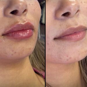 a client with skin care treatment before and after picture